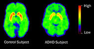 ADHD-DAT-300.jpg